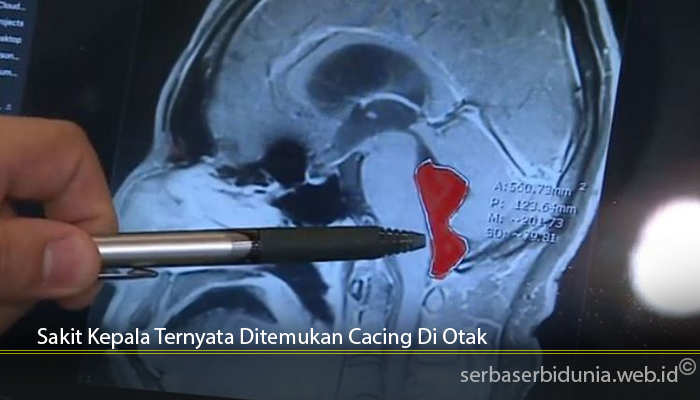 Sakit Kepala Ternyata Ditemukan Cacing Di Otak